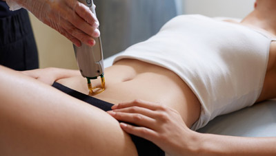 LASER ΑΠΟΤΡΙΧΩΣΗ ΣΑΡΩΝΙΔΑ